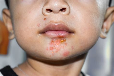Impetigo .